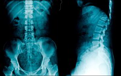 Radiografía de columna vertebral, herramienta eficaz para detección de lesiones